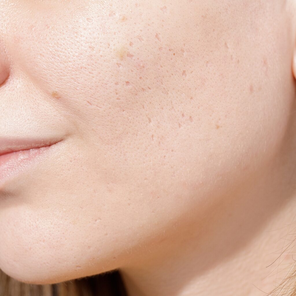 acne scars2 Blog 37 Young woman with acne scars on her face